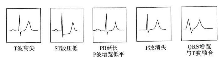 细数心电图上的那些变态t波