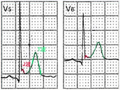细数心电图上的那些变态t波