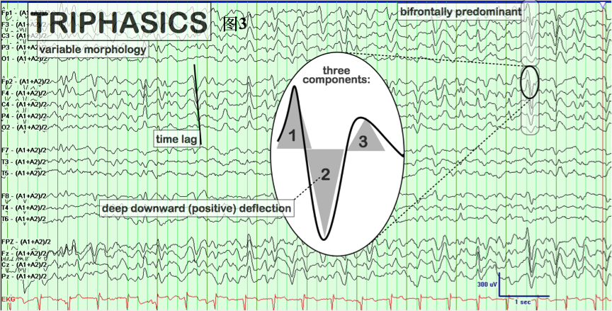 一文掌握脑电图上的三相波
