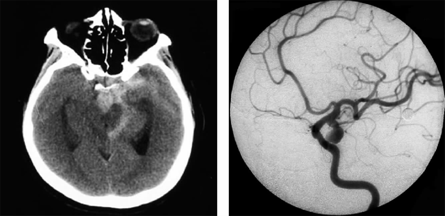 左侧后交通动脉瘤伴脚间池积血.