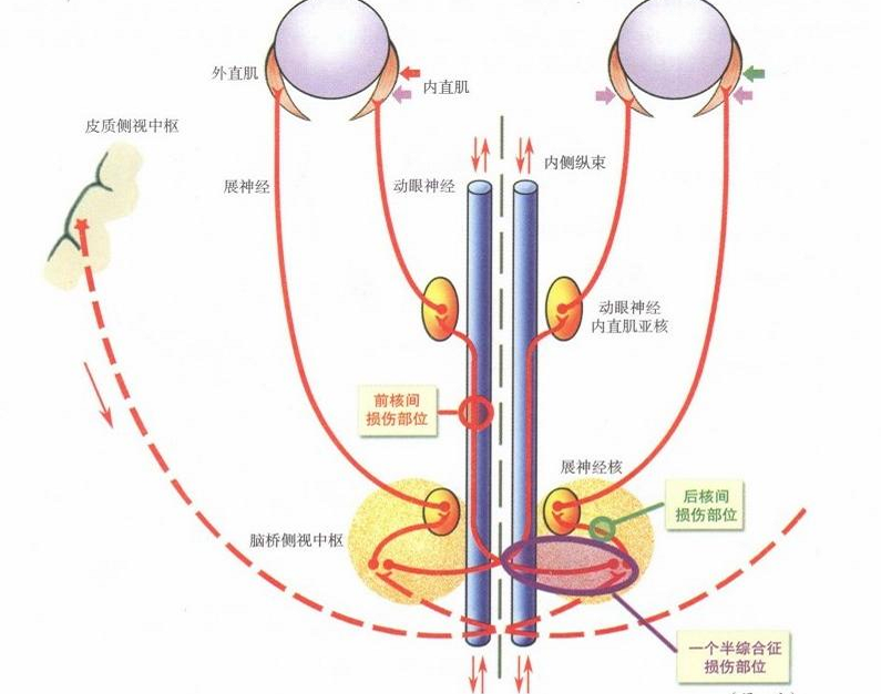 一劳永逸地弄懂核间性眼肌麻痹