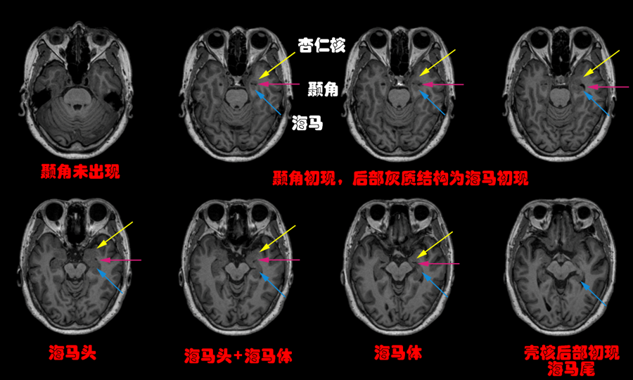 颞角前面的灰质是杏仁核,颞角后面逐渐出现海马,如下面的核磁图(图3)