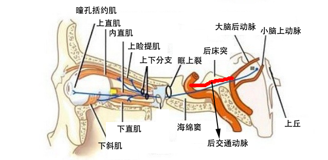 看美剧,聊动眼神经麻痹与颅内动脉瘤的前世今生