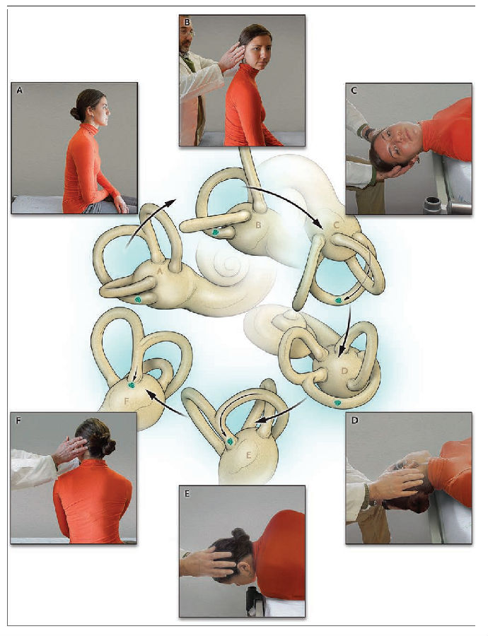 眩晕的主力军——耳石症(bppv)