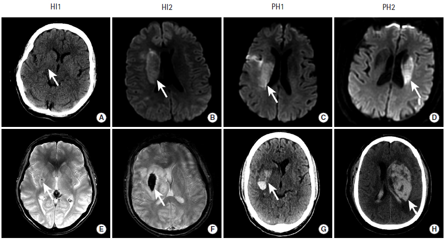 出血性脑梗死(hemorrhagic infarction,hi)