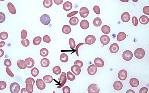 这些红细胞异常您都掌握了吗
