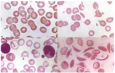 常见于肝病,脾切除,无p脂蛋白血症; 泪滴状红细胞常见于骨髓纤维化