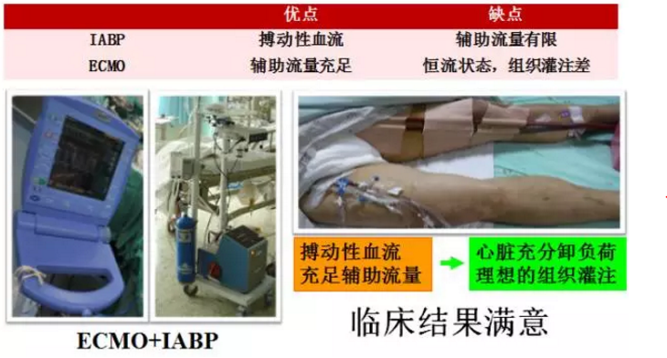 ecmo iabp在心衰患者中的应用