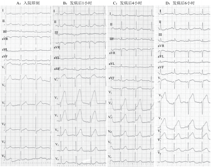 【st段抬高型心肌梗死的心电图诊断】-中华医学网-131