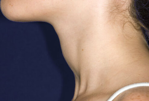 正常人的甲状腺不可扪及,如能在体检时扪及甲状腺,一般认为甲状腺肿