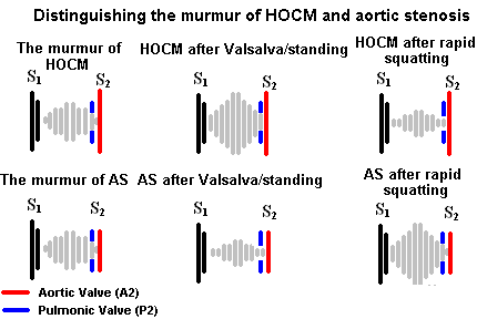 在hocm患者中,valsalva动作可使肥厚                    心室,导致更