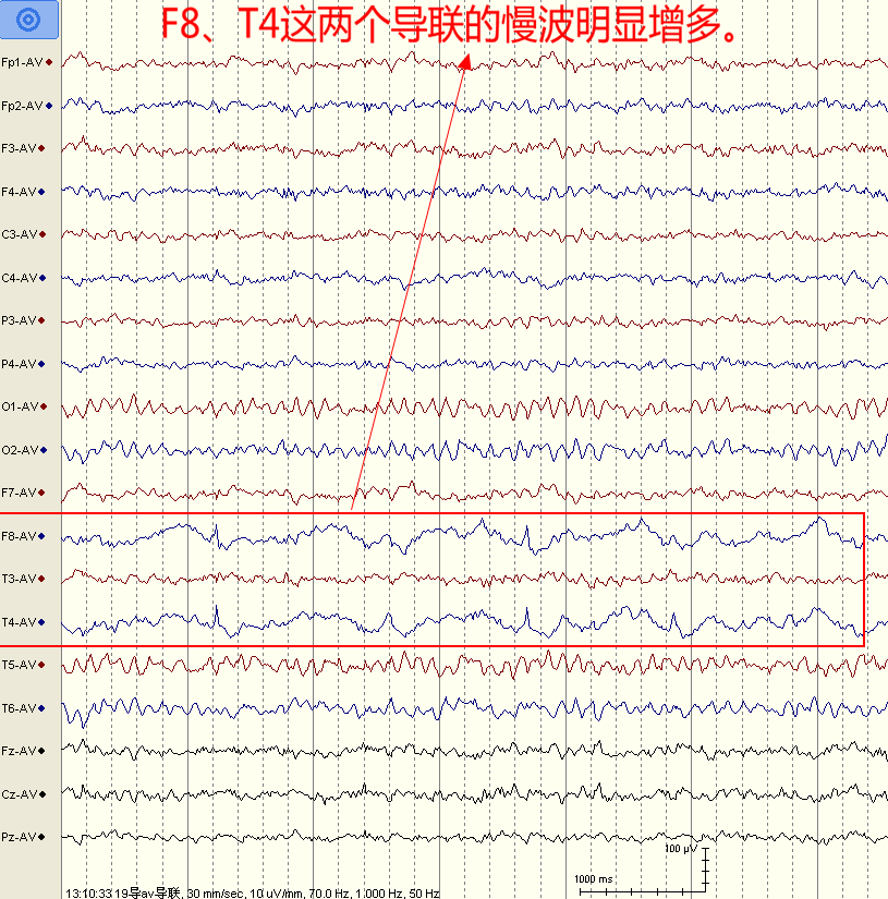 棘波所在的导联往往背景也会出现异常,一般表现为所在的导联慢波增多