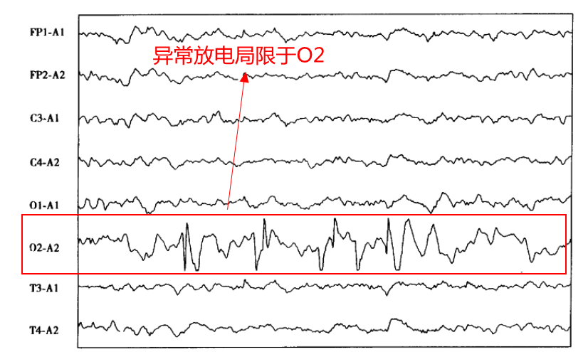 图5 图6 (所以脑电图的电极位置还是要知道的,这样才能知道异常放电