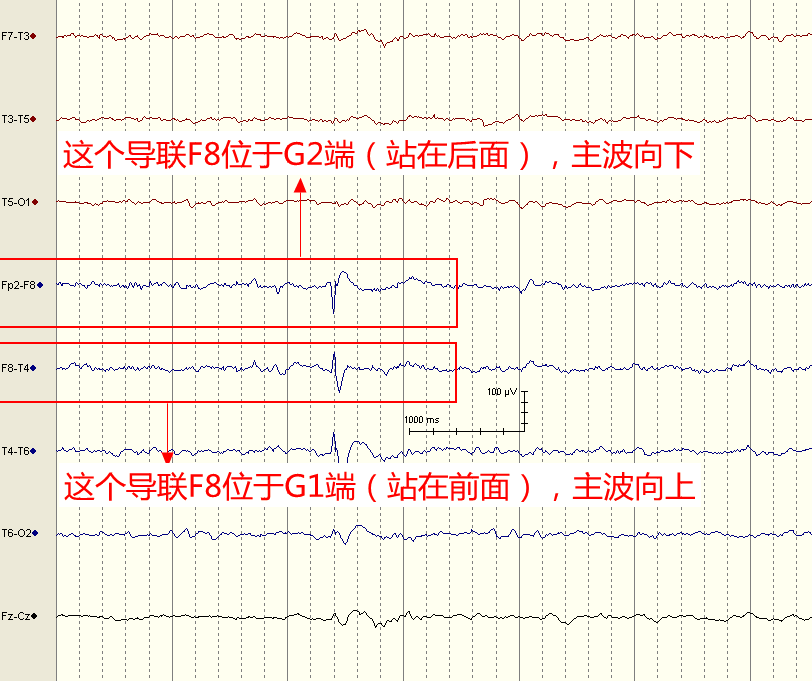 图10  f8在相邻的两个导联分别位于g2端,g1端,因为波形相反,形成了