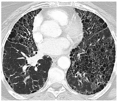 ct特点诊断寻常型间质性肺炎(uip) 图1:63岁男性,患特发性肺纤维化及