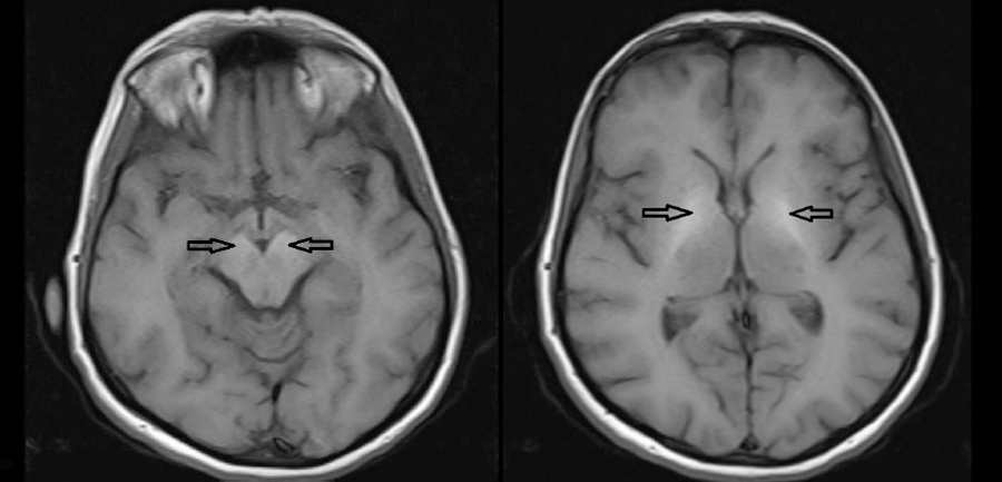t2wi高信号病灶图10:ahcd患者的可见双侧小脑齿状核对称t1wi低信号