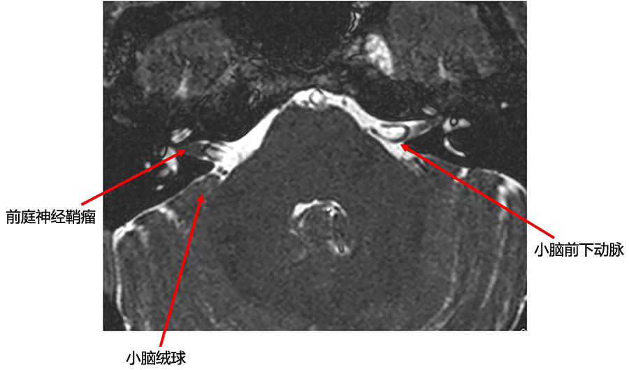多图桥小脑角区正常影像解剖及常见病变