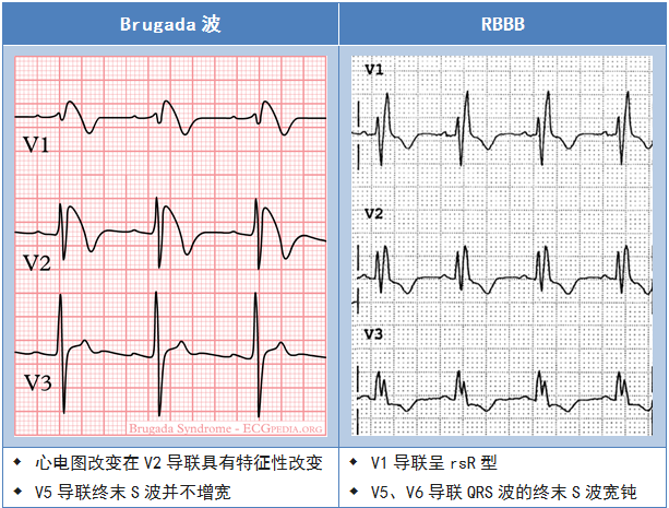 表2 brugada波与右束支传导阻滞的心电图区别