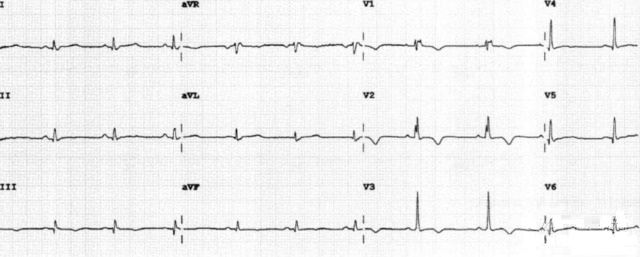 心电图老也搞不清的那些波啊epsilon波