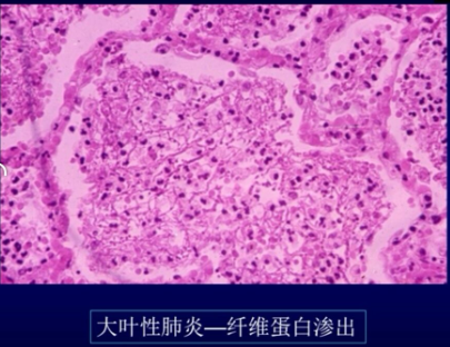 教授:肺内渗出性病变的影像学特点  渗出性炎症的类型 ▲  浆液性炎症