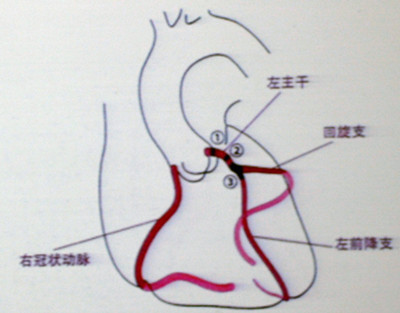 图14 冠脉左主干闭塞示意图:①左主干开口部病变;②左主干躯干部闭塞