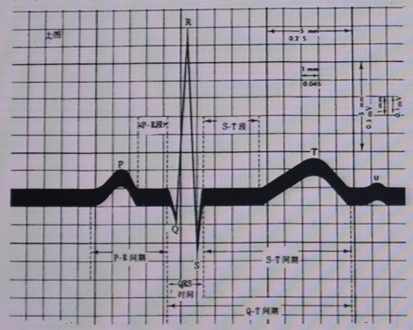 [chrs2017]卢喜烈:19个图例,教你掌握心电图阅读及诊断技巧