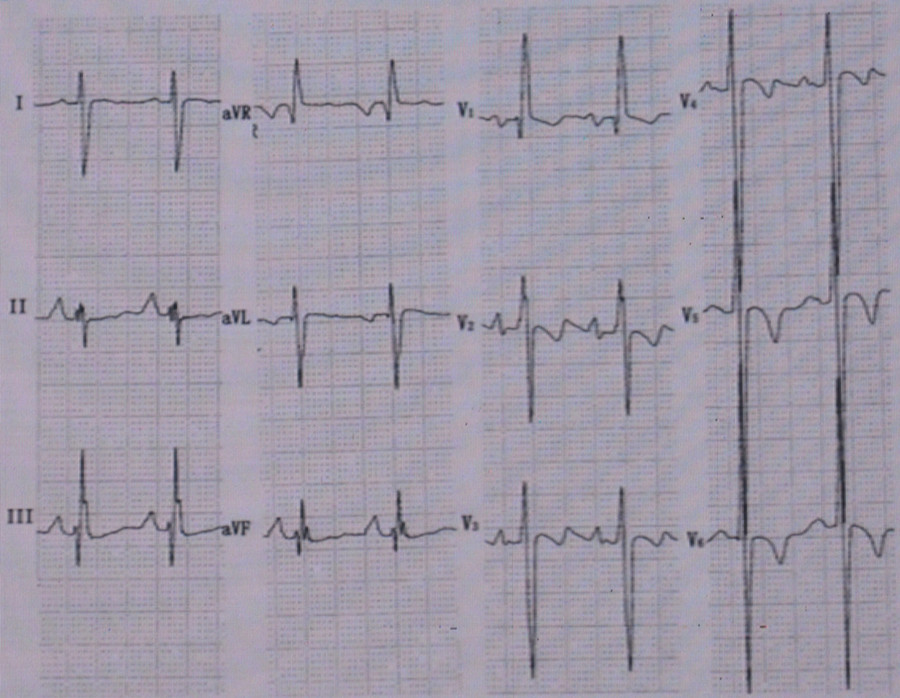 ③常伴房性快速性心律失常,可见房早,房颤等;④常有风心病,二尖瓣狭窄