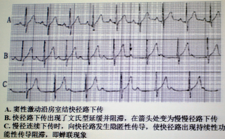 房室结双径路慢径下传型蝉联现象