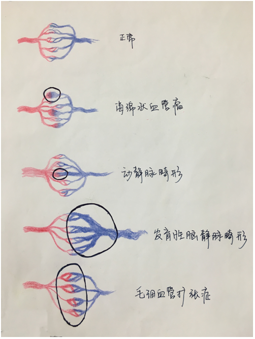 venous anomalies, dva): 关键词:水母头