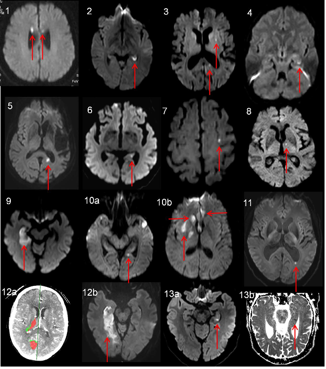 失忆性缺血患者的弥散加权成像(dwi)磁共振成像(mri)检查