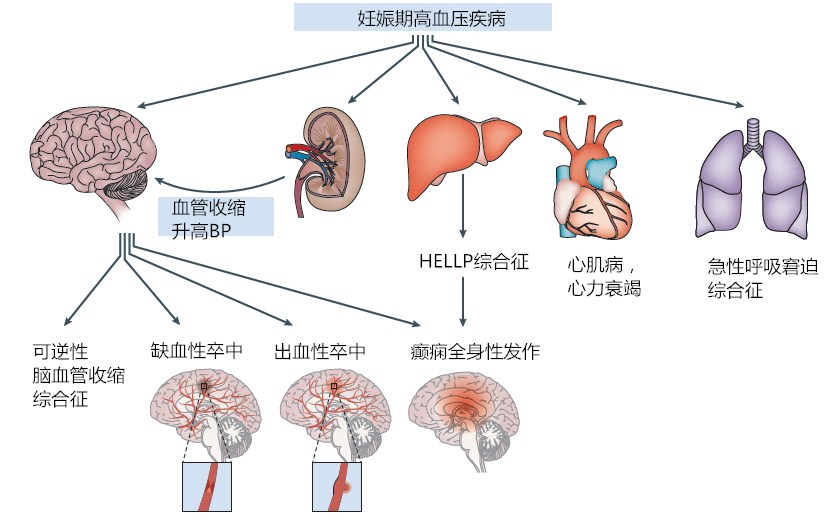 妊娠期高血压疾病