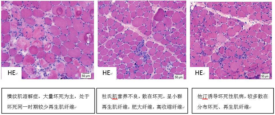 【图表】全面解读横纹肌溶解症