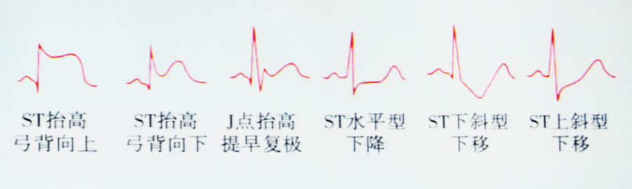 心电图st-t改变类型心肌梗死上图患者avr导联,v1导联st段抬高,而ii