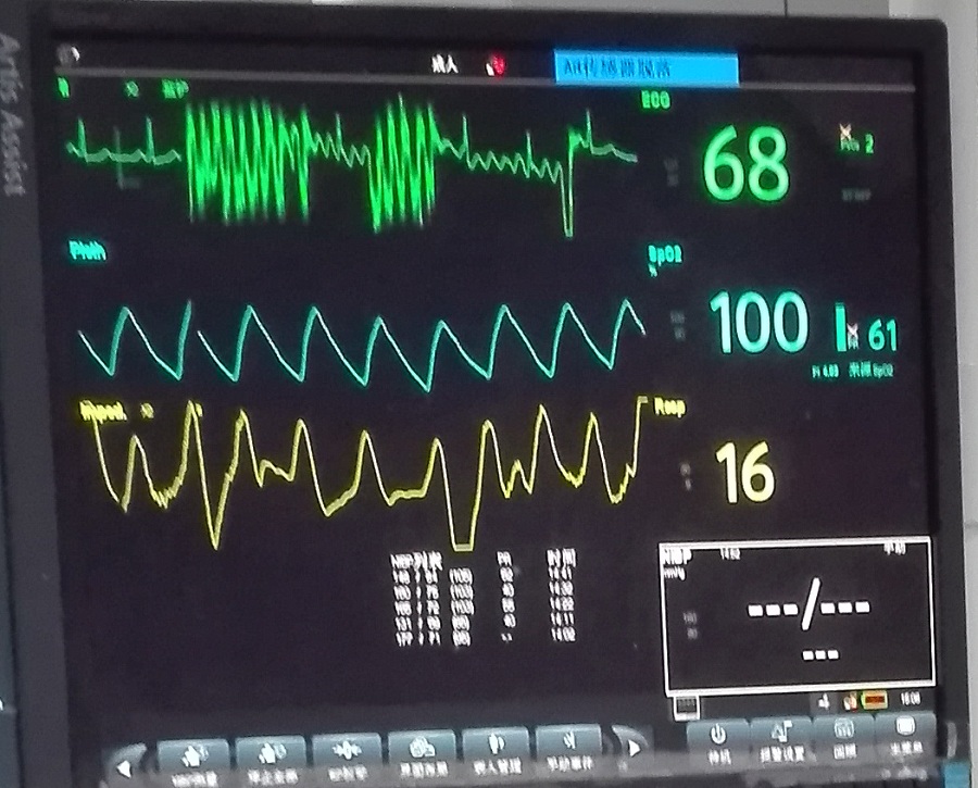 监护仪频报「室颤」,吓慌实习大夫