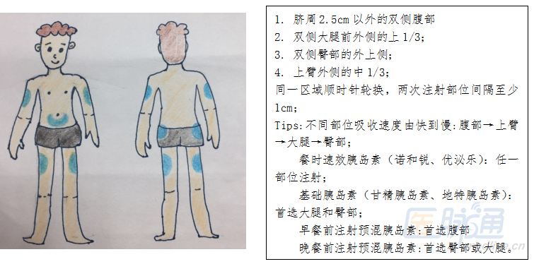 图文掌握丨注射胰岛素那些事儿