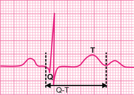 导读:qt间期的测量从q波起始至t波(非u波)结束,包括qrs波时限,st段