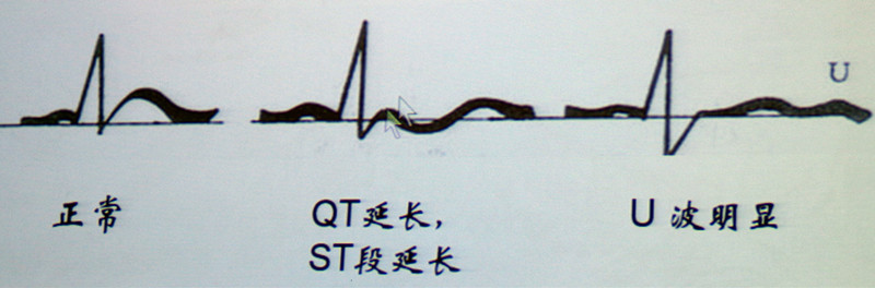 血镁低于0.8mmol/l为低镁血症.心电图可见:qtc延长,房早和室早