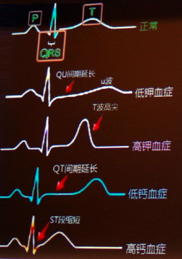 8mmol/l为低镁血症.心电图可见:qtc延长,房早和室早,tdp等.