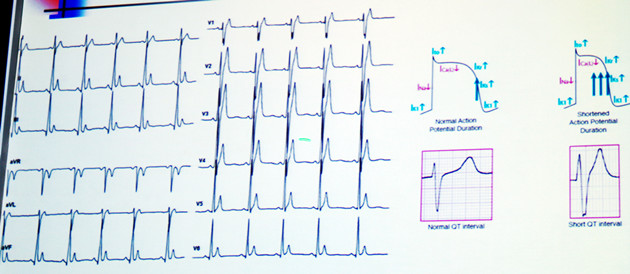 [长城会2017]刘元生教授:心电图出现这些改变,当心恶性心律失常