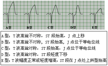 一文搞定,超急性t波的心电图特征和鉴别诊断