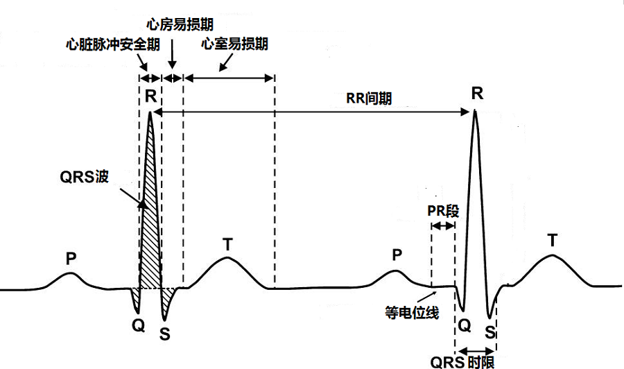 p-on-t现象是指患者发生心律失常时,心电图有异位p波落在t波之上的