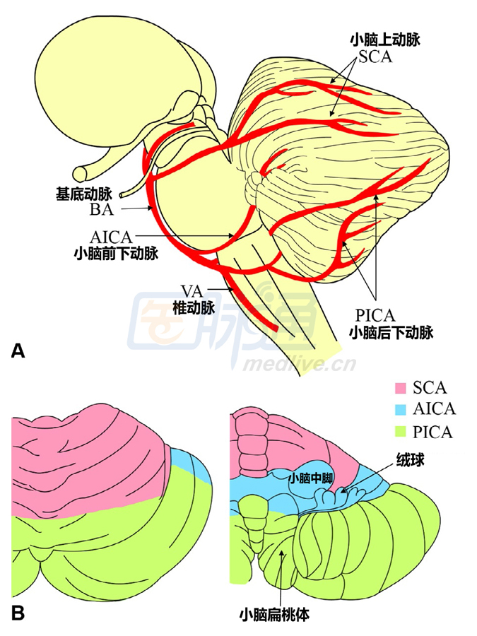 小脑不同部位梗死各有哪些特点?一图一表来教你