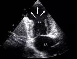 室壁瘤的超声心电图表现