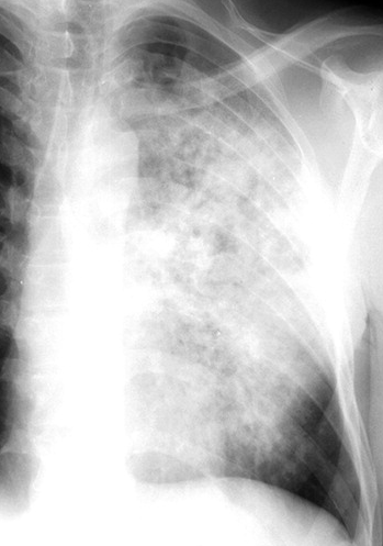 原发性肺结核的4种胸片特征