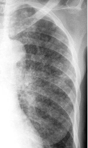 原发性肺结核的4种胸片特征  在结核病的类型中,1%至7%的病例表现为粟
