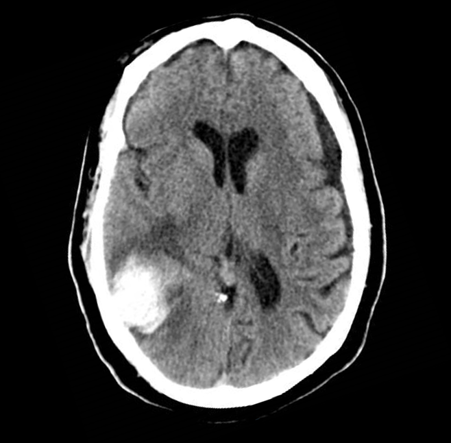 图1  患者的头部ct平扫显示右侧颞顶叶脑出血,病灶最大截面尺寸约为3.