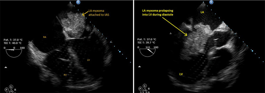 超声心动图显示左心房粘液瘤附着于房间隔,并在舒张期间突入左