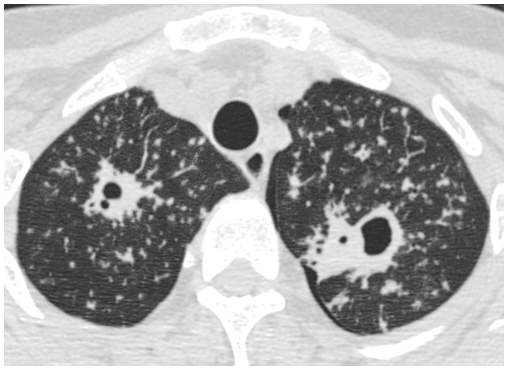 空洞是继发性肺结核的特征表现,发生率约为50%.