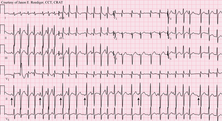 多源性房性心动过速(multifocal atrial tachycardia,mat)也表现为p波