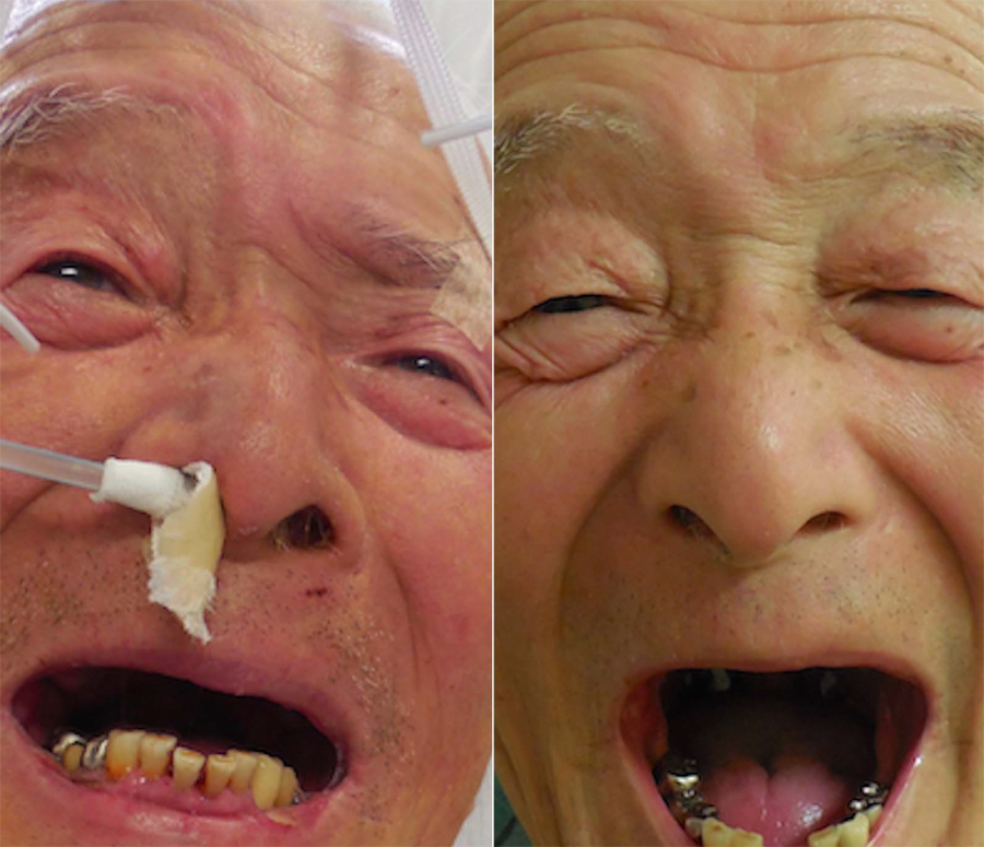 左图显示患者伤后第24天首次拔管后出现了张口受限和苦笑面容;右图